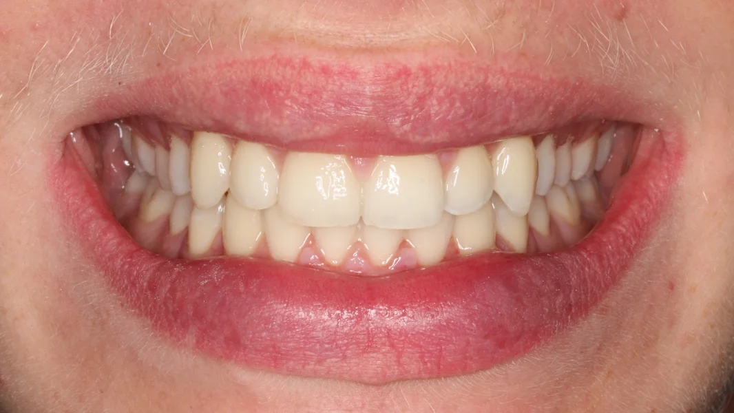 Invisalign metamorfoza - po