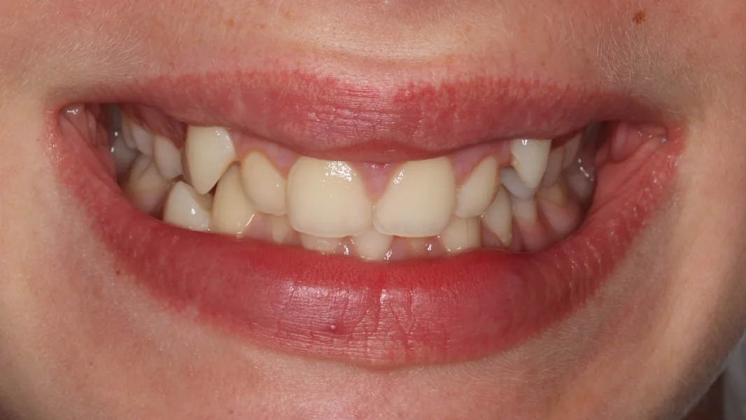 Invisalign metamorfoza - przed