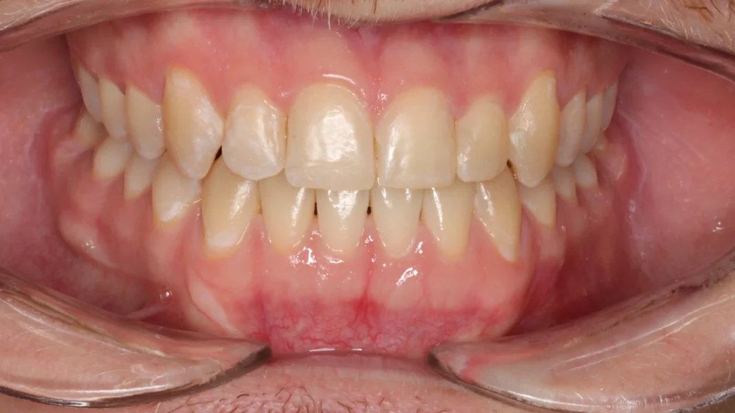 Invisalign metamorfoza - po