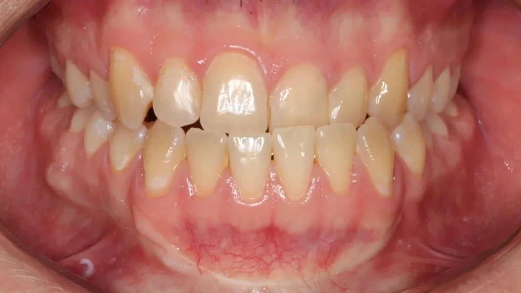 Invisalign metamorfoza - przed