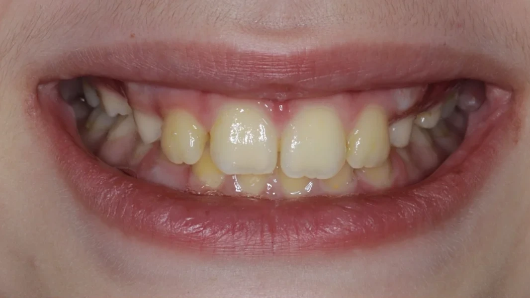 Invisalign metamorfoza - po