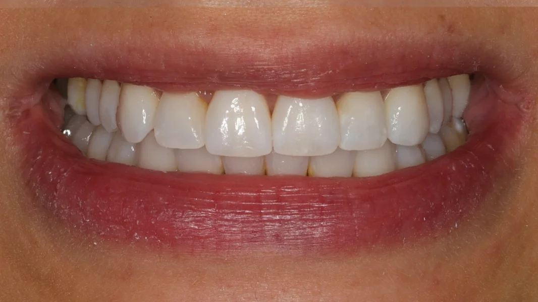 Invisalign metamorfoza - po