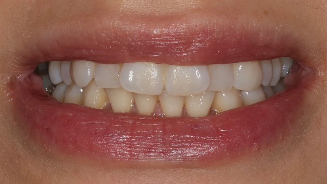 Invisalign metamorfoza - przed